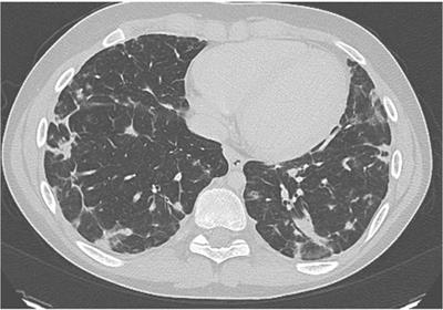 Up, Down, and All Around: Diagnosis and Treatment of Novel STAT3 Variant